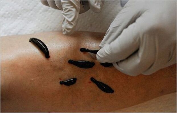 treatment of knee arthrosis with leeches