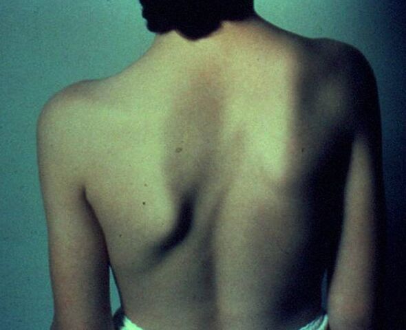 Sprengel disease as a cause of pain under the left shoulder blade