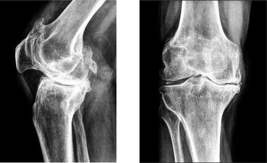 X-ray of the knee gonarthrosis