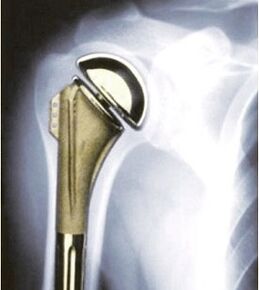 shoulder prostheses for arthrosis