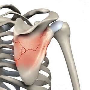 Fracture of the shoulder blade is one of the causes of severe pain