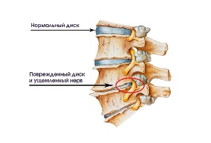 The symptoms of cervical degenerative disease of the disk