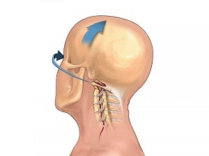 how manifests cervical spine osteochondrosis