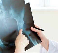 how to treat hip arthrosis