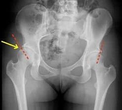 methods for treating hip arthrosis