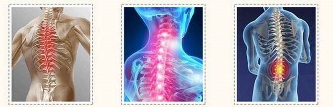 spinal lesions in osteochondrosis