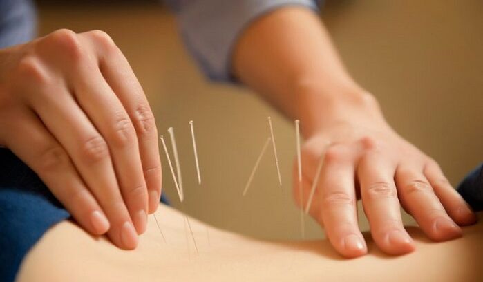 acupuncture for the treatment of low back pain